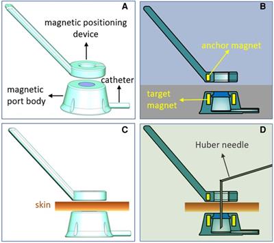 Value of a novel Y-Z magnetic totally implantable venous access port in improving the success rate of one-time needle insertion